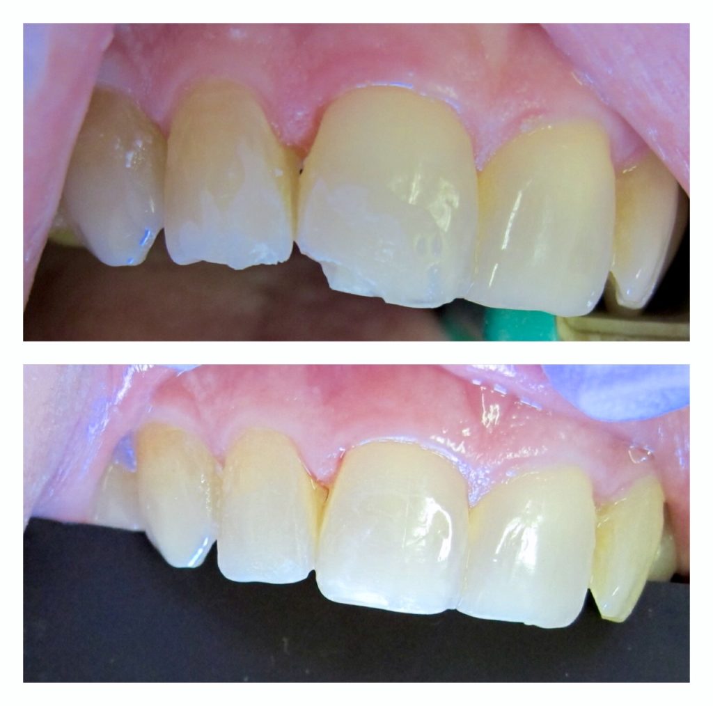 Composite Bonding Before and After