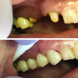 Bridge Before and After images